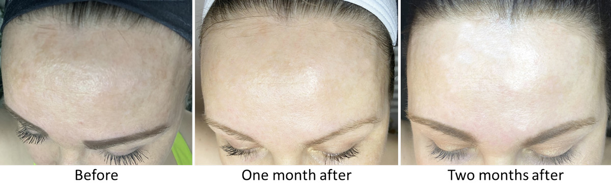 Micro-needling Niagara