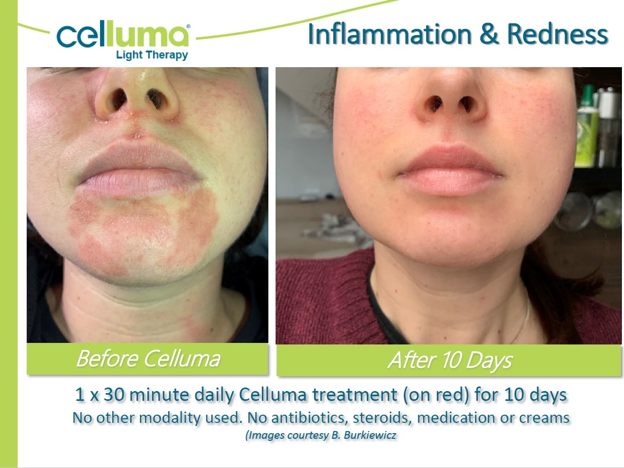 Inflammation & Redness before and after