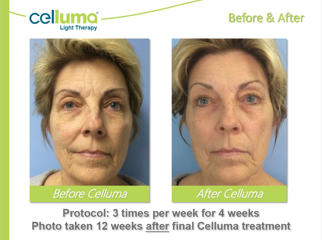 Skin Rejuvenation before and after