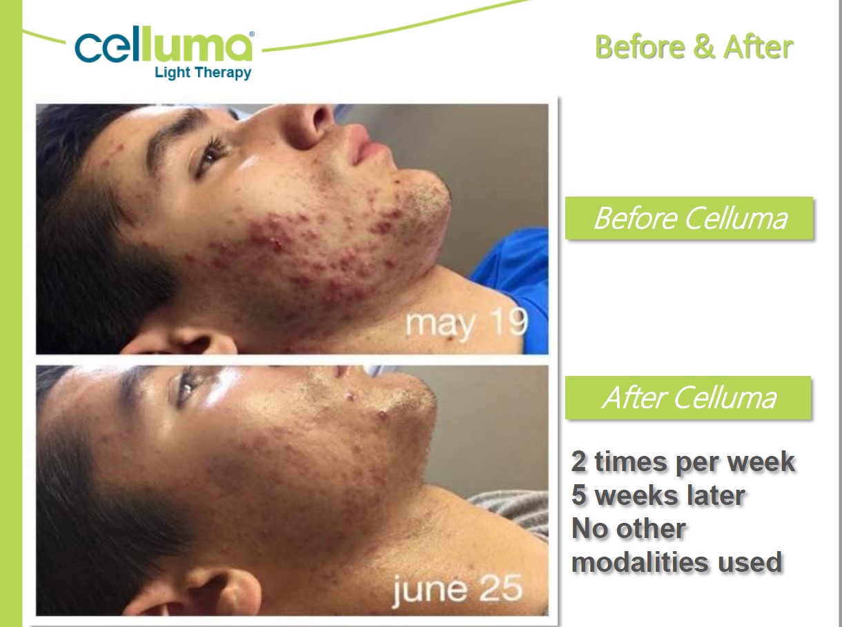 Acne Support before and after