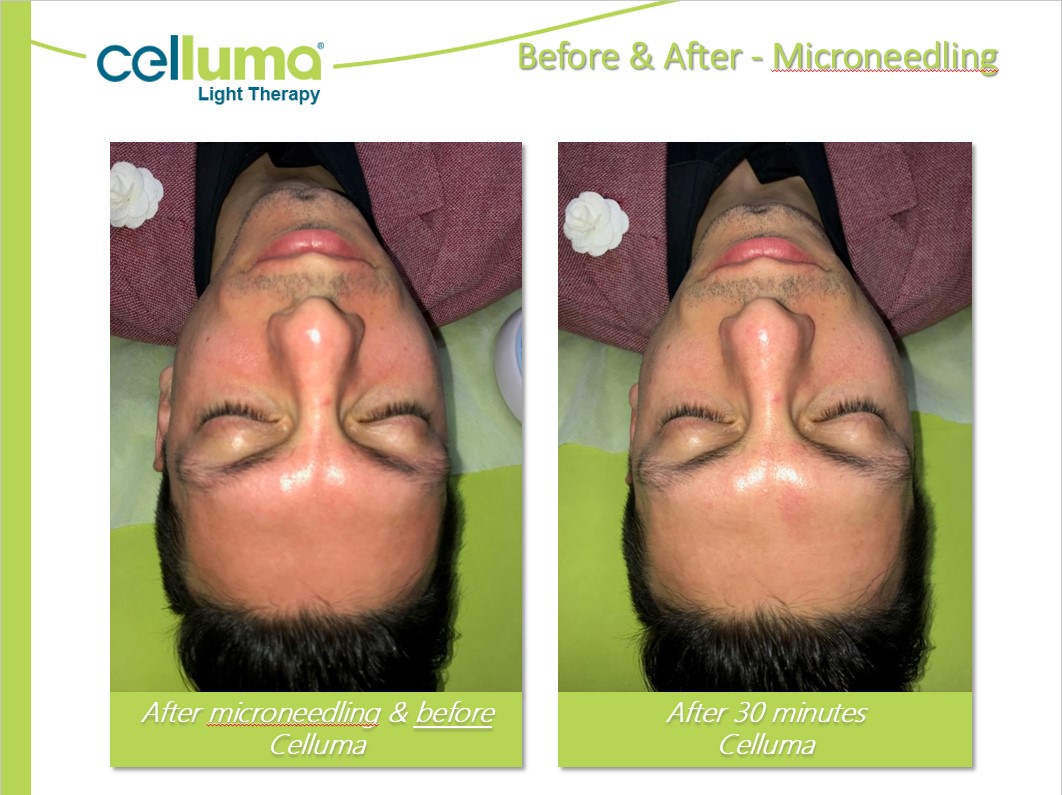 Microneedling + Celluma before and after