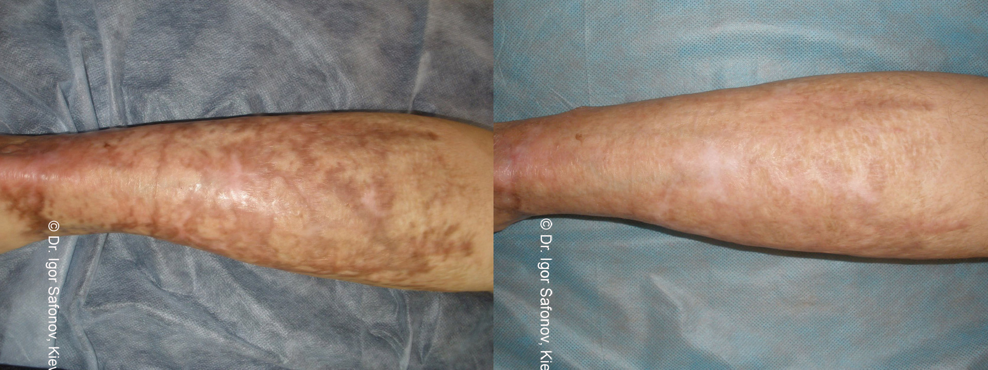 Microneedling Acne Scarring before and after