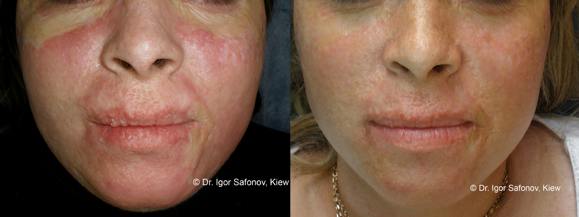 Microneedling Acne Scarring before and after