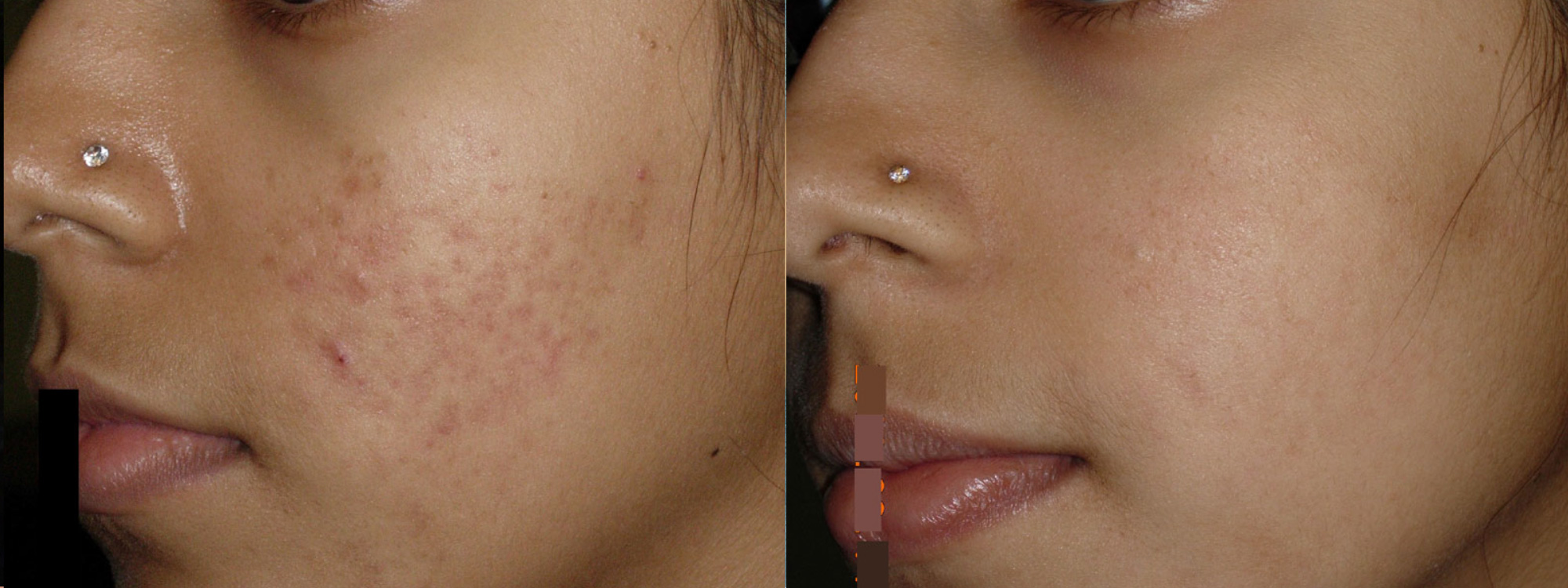 Microneedling Acne Scarring before and after