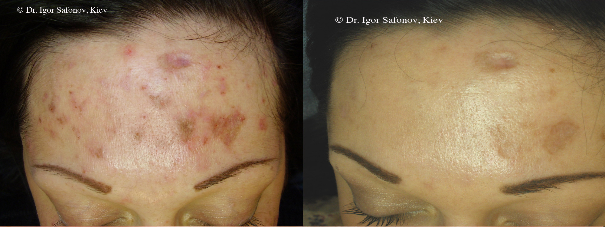 Microneedling Acne Scarring before and after