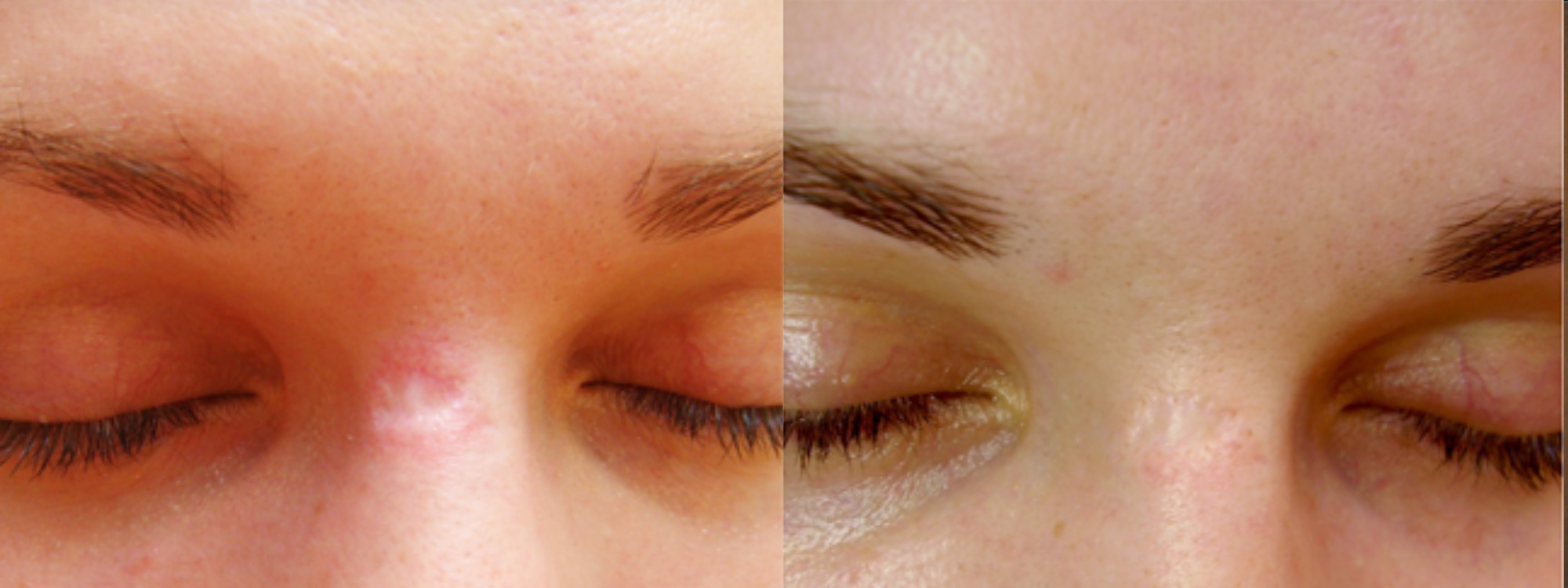 Microneedling Acne Scarring before and after