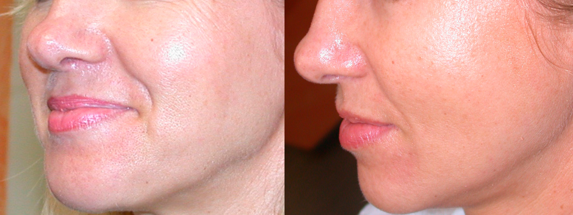 Microneedling Skin Tightening before and after