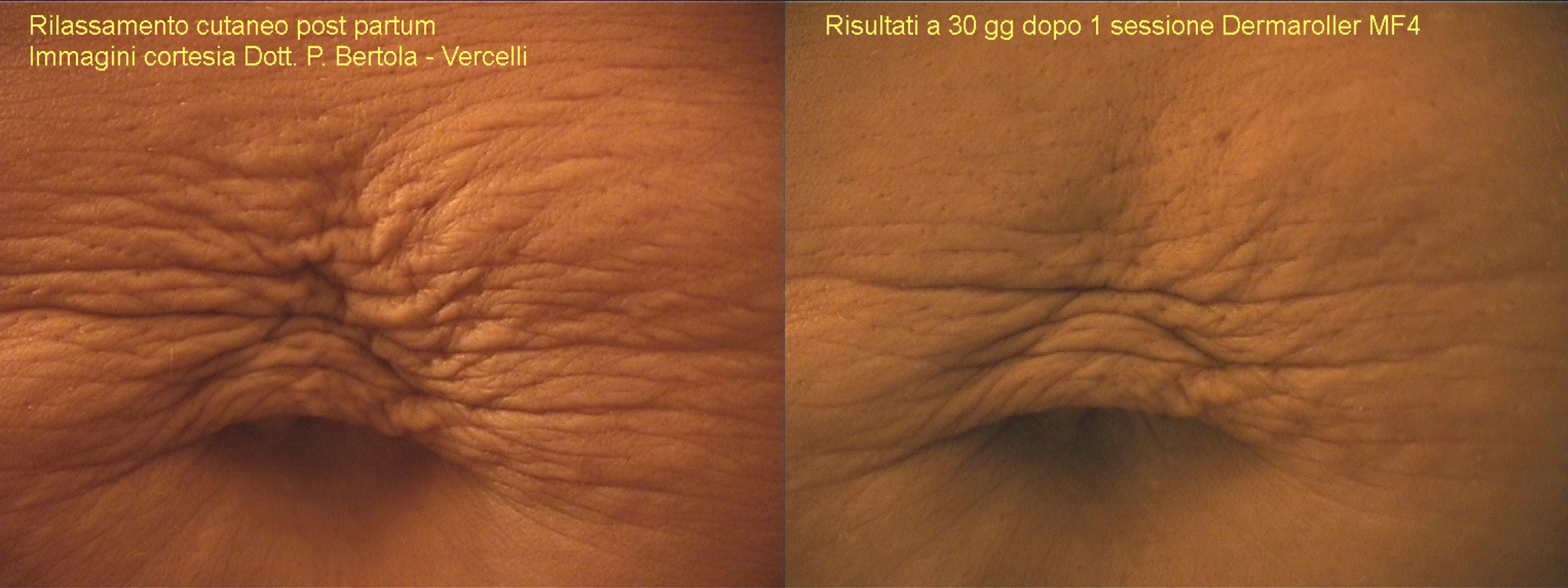 Microneedling Stretch Marks before and after