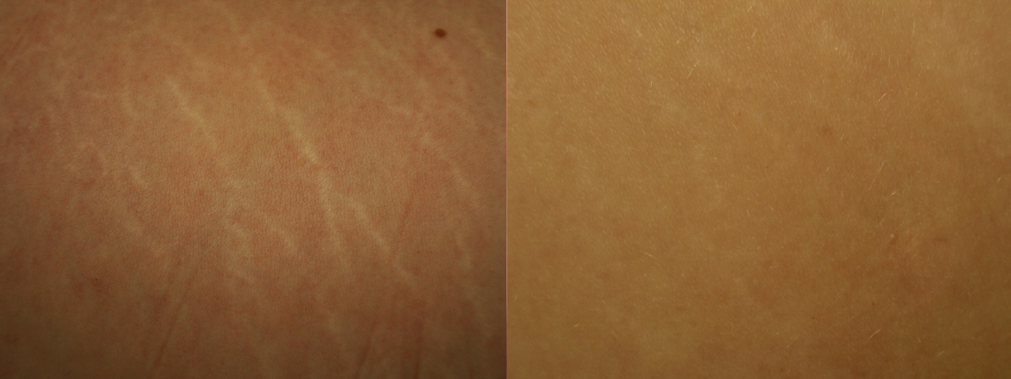 Microneedling Stretch Marks before and after