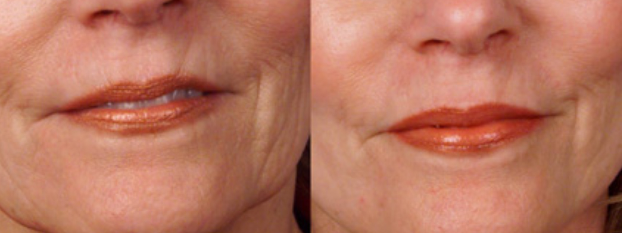 Microneedling Wrinkles before and after