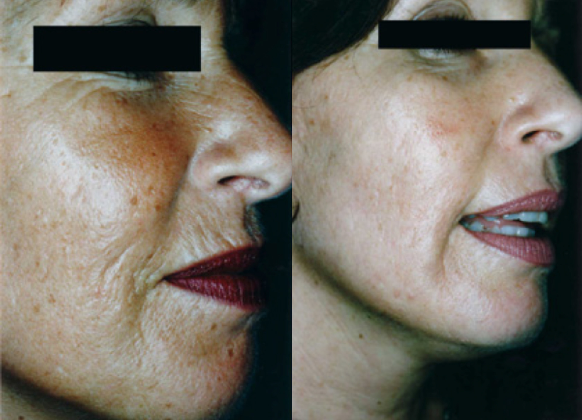 Microneedling Wrinkles before and after